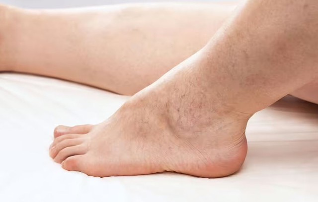 "Khi bạn bị sưng chân, đó có thể là dấu hiệu của bệnh suy tim", bác sĩ Portela nói. (Ảnh minh họa)